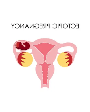 Ectopic Pregnancy